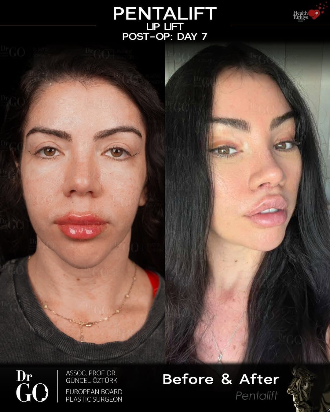 Assoc. Prof. Dr. Güncel Öztürk — Pentalift before and after