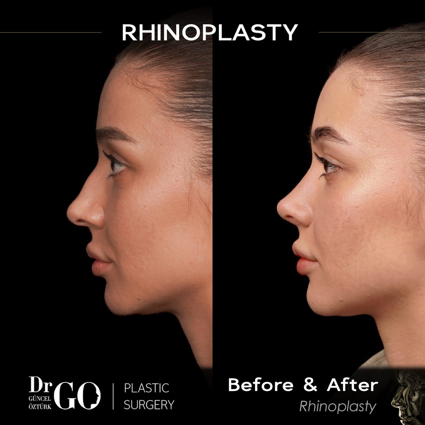 Assoc. Prof. Dr. Güncel Öztürk — Rhinoplasty before and after