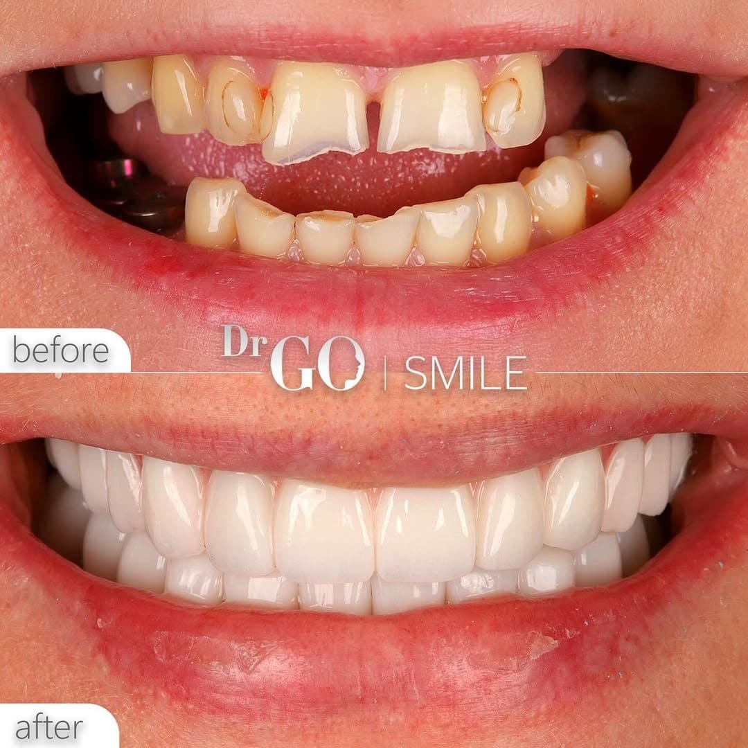 DRGO Smile — Smile makeover before and after