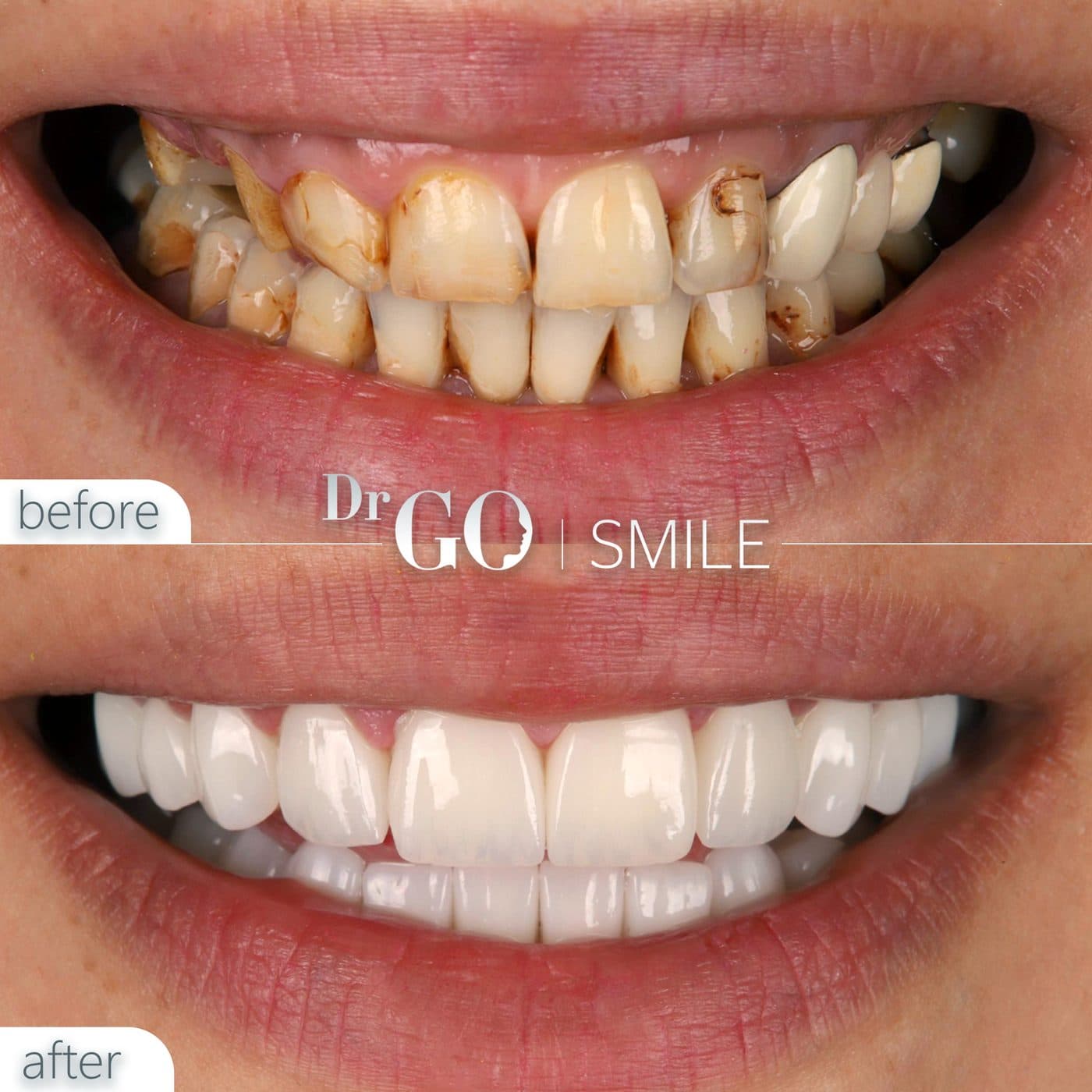 DRGO Smile — Smile makeover before and after