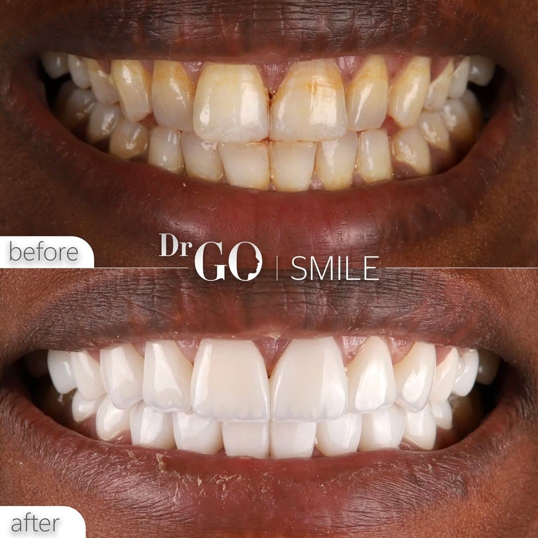 DRGO Smile — Smile makeover before and after