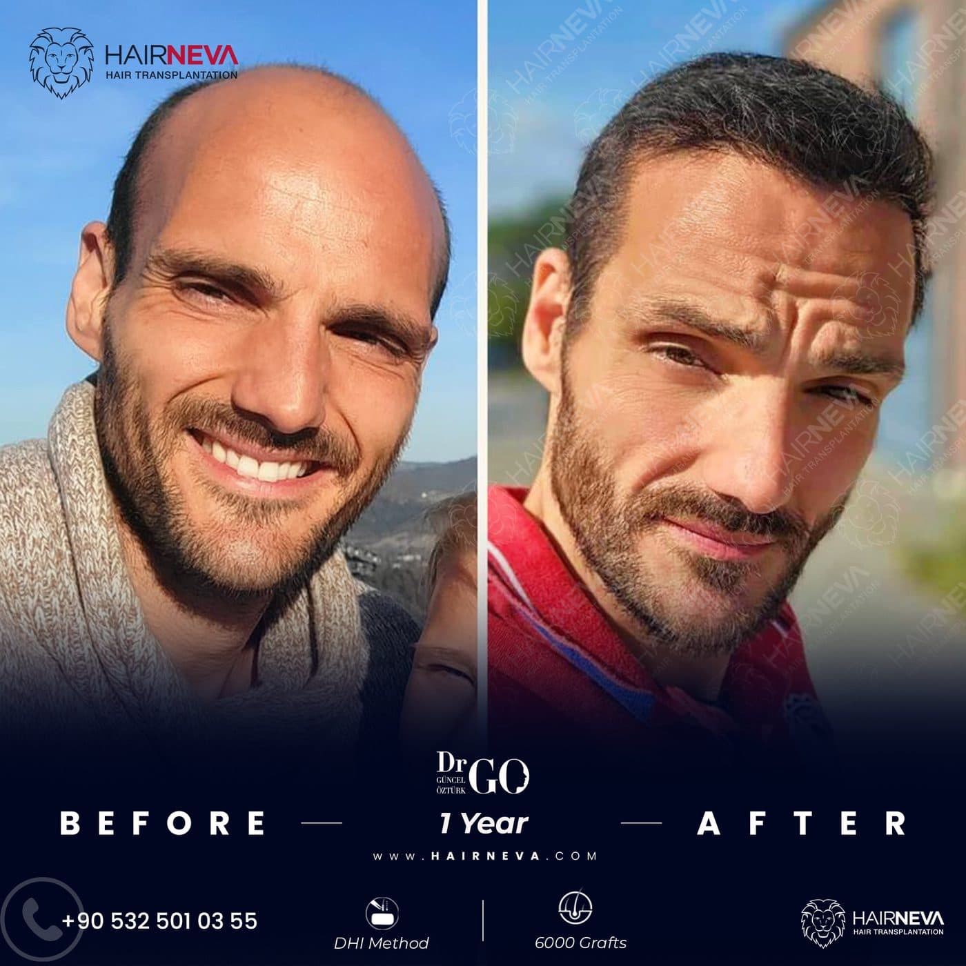 HairNeva — Hair transplant before and after