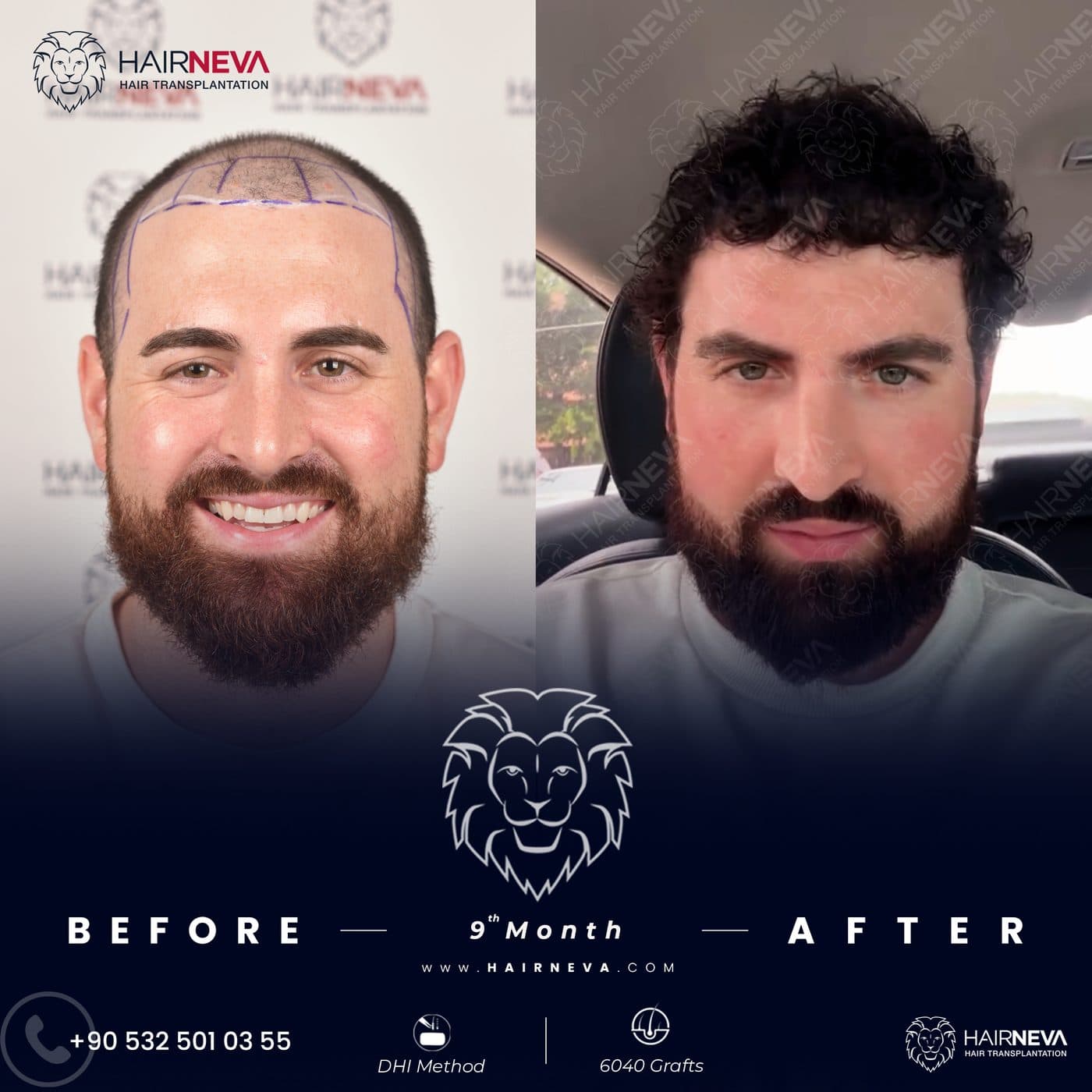 HairNeva — Hair transplant before and after