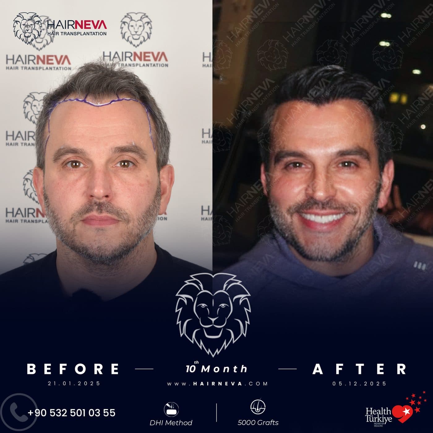 HairNeva — Hair transplant before and after